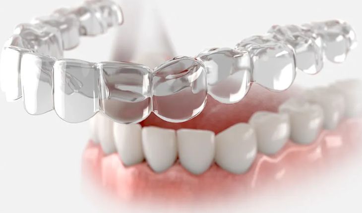 Service Provider of Teeth Invisalign in Ghaziabad, Uttar Pradesh, India.