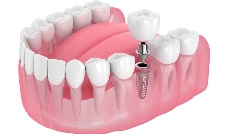 Service Provider of Dental Implants in Ghaziabad, Uttar Pradesh, India.