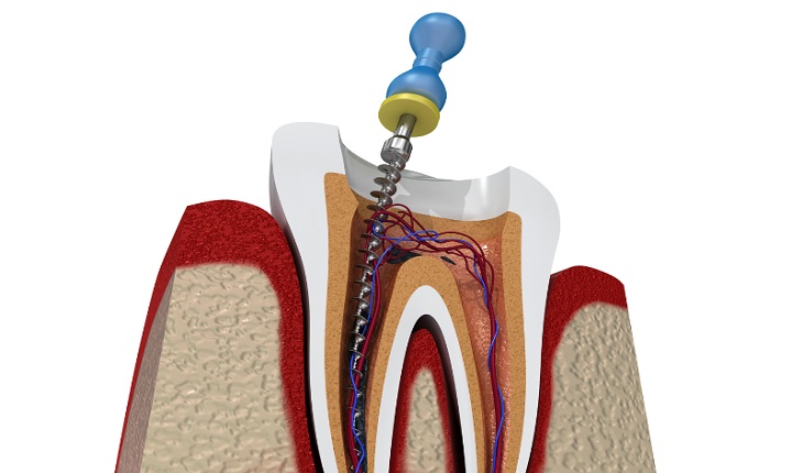 Root Canal Treatment Cost