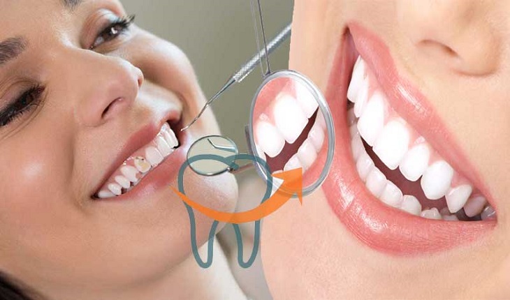 Smile Treatment in Ghaziabad